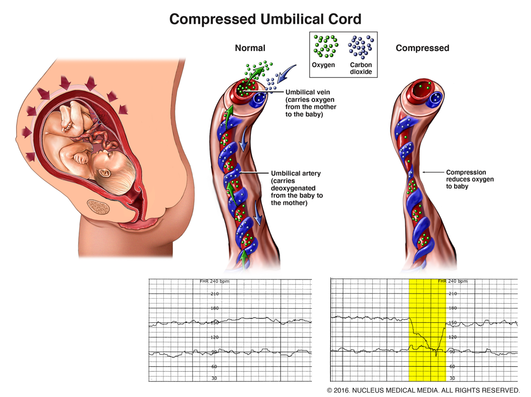 Umbilical cord compression - Wikipedia